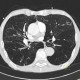 Bronchitis, panlobular emphysema: CT - Computed tomography